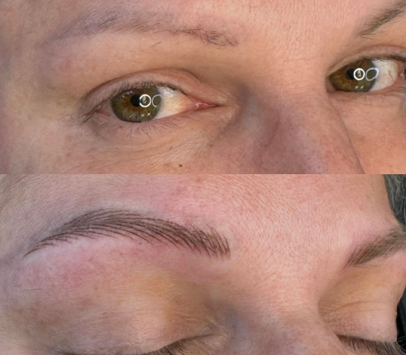 before and after brow correction